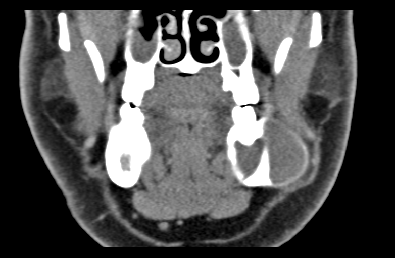 File:Ameloblastoma (Radiopaedia 33677-34806 Coronal non-contrast 26).png