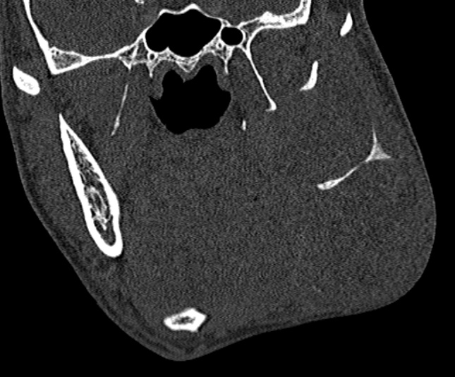 Ameloblastoma (Radiopaedia 51921-57766 Coronal bone window 137).jpg