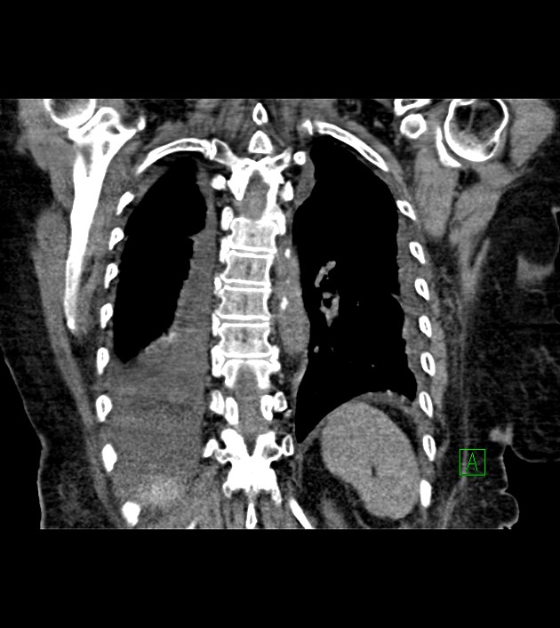 Amiodarone deposition in the liver (Radiopaedia 77587-89780 Coronal non-contrast 58).jpg