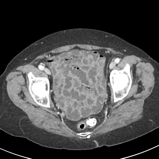 Ampullary adenocarcinoma (Radiopaedia 34013-35237 C 50).png