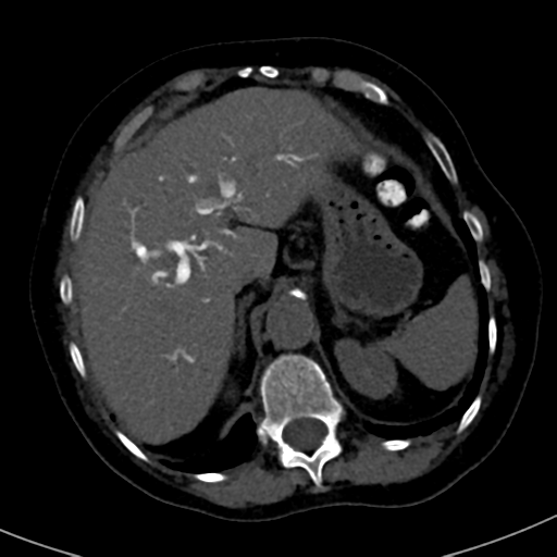 File:Ampullary adenocarcinoma (Radiopaedia 34013-35241 AXIAL THICK 17).png