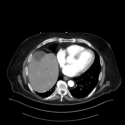 Ampullary adenocarcinoma (Radiopaedia 59373-66734 A 23).jpg
