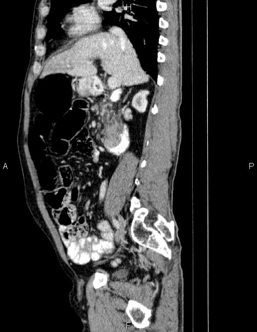 Ampullary adenocarcinoma (Radiopaedia 86093-102032 D 36).jpg