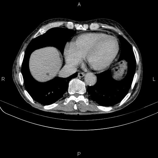 Ampullary adenocarcinoma (Radiopaedia 86093-102033 Axial C+ delayed 8).jpg