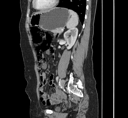 File:Ampullary tumor (Radiopaedia 60333-67998 C 41).jpg