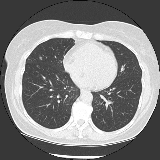 Amyloidosis - bronchial and diffuse nodular pulmonary involvement (Radiopaedia 60156-67744 B 37).jpg