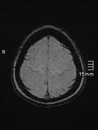 Amyotrophic lateral sclerosis (Radiopaedia 70821-81017 Axial SWI 49).jpg