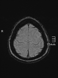 Amyotrophic lateral sclerosis (Radiopaedia 70821-81017 Axial SWI 51).jpg