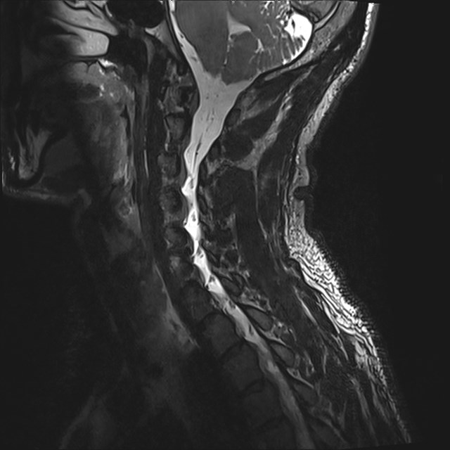 Amyotrophic lateral sclerosis (Radiopaedia 87352-103658 I 18).jpg