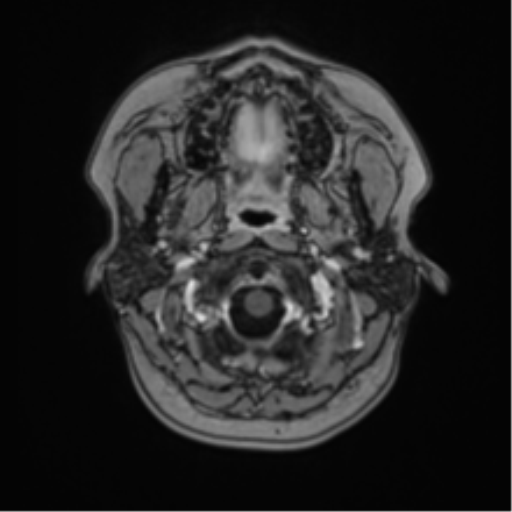 File:Anaplastic astroblastoma (Radiopaedia 55666-62194 Axial T1 C+ 4).png