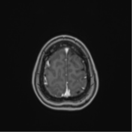 Anaplastic astroblastoma (Radiopaedia 55666-62194 Axial T1 C+ 67).png