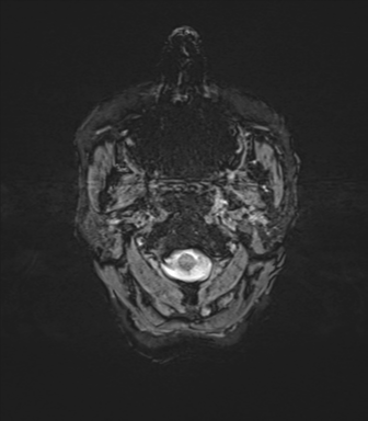 File:Anaplastic astrocytoma (Radiopaedia 86943-103160 Axial SWI 1).png