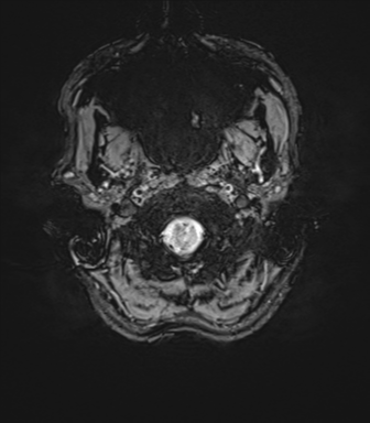 File:Anaplastic astrocytoma IDH mutant (Radiopaedia 50046-55341 Axial SWI 6).png