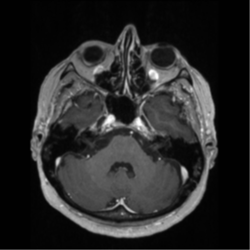 File:Anaplastic astrocytoma IDH wild-type (pseudoprogression) (Radiopaedia 42209-45276 Axial T1 C+ 43).png