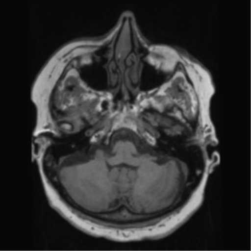 File:Anaplastic astrocytoma IDH wild-type (pseudoprogression) (Radiopaedia 42209-45278 Axial T1 43).png