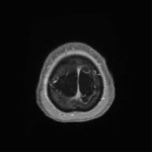 Anaplastic astrocytoma IDH wild-type (pseudoprogression) (Radiopaedia 42209-45278 Axial T1 C+ 144).png