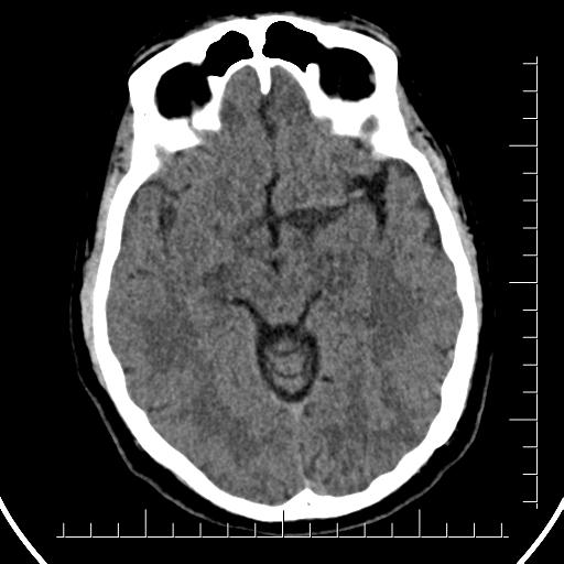 File:Aneurysm of posterior communicating artery (Radiopaedia 20188-20162 Axial non-contrast 20).jpg