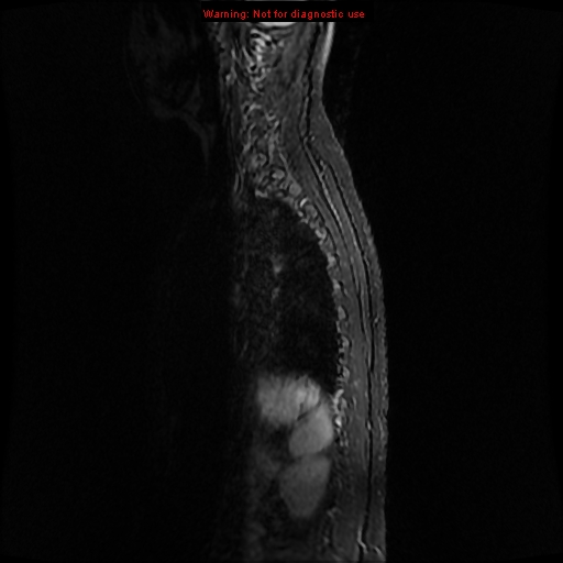File:Aneurysmal bone cyst (Radiopaedia 9419-10103 Sagittal T2 12).jpg