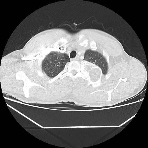Aneurysmal bone cyst - rib (Radiopaedia 82167-96220 Axial lung window 17).jpg
