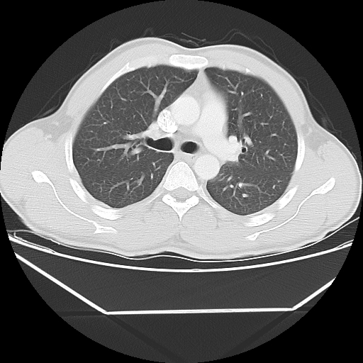 File:Aneurysmal bone cyst - rib (Radiopaedia 82167-96220 Axial lung window 29).jpg
