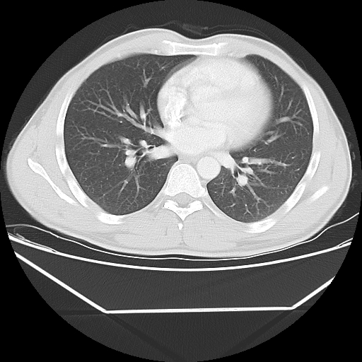 File:Aneurysmal bone cyst - rib (Radiopaedia 82167-96220 Axial lung window 39).jpg