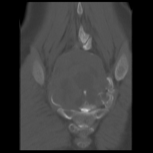 File:Aneurysmal bone cyst - sacrum (Radiopaedia 65190-74195 Coronal bone window 12).jpg
