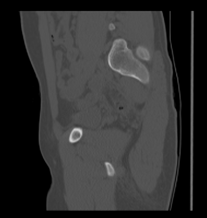 Aneurysmal bone cyst of ischium (Radiopaedia 25957-26094 Sagittal bone window 29).png