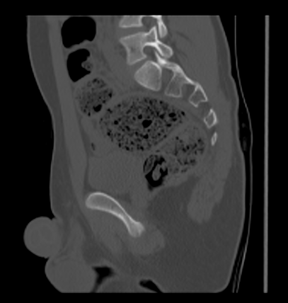 Aneurysmal bone cyst of ischium (Radiopaedia 25957-26094 Sagittal bone window 42).png