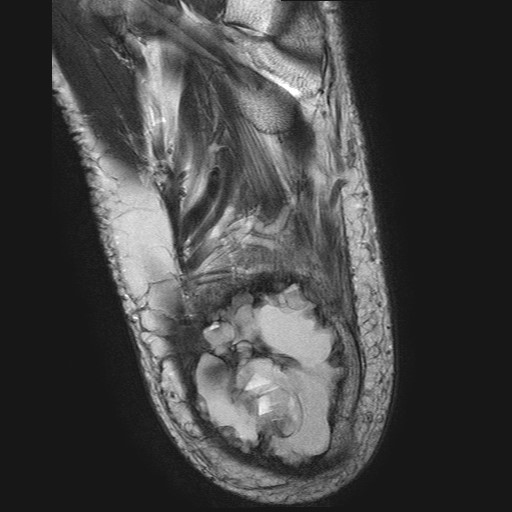 File:Aneurysmal bone cyst of the calcaneus (Radiopaedia 60669-68420 Axial T2 5).jpg