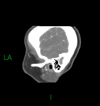 Aneurysmal subarachnoid hemorrhage with intra-axial extension (Radiopaedia 84371-99732 B 63).jpg