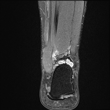 Ankle syndesmotic injury (Radiopaedia 69066-78837 Coronal PD fat sat 16).jpg