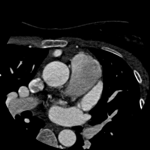File:Anomalous left coronary artery from the pulmonary artery (ALCAPA) (Radiopaedia 40884-43586 A 8).jpg
