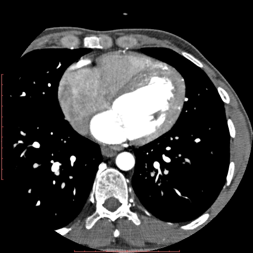 File:Anomalous left coronary artery from the pulmonary artery (ALCAPA) (Radiopaedia 70148-80181 A 220).jpg