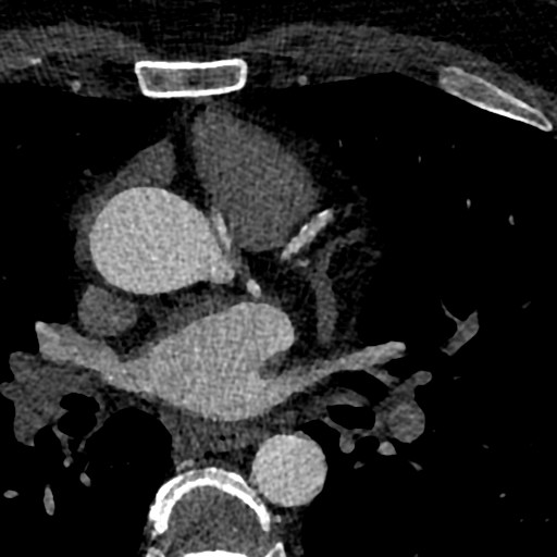 File:Anomalous origin of the left coronary artery with malignant course (Radiopaedia 77842-90126 C 28).jpeg