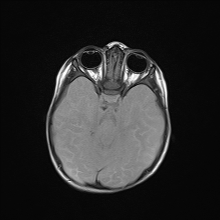 File:Anoxic brain injury (Radiopaedia 79165-92139 Axial FLAIR 10).jpg