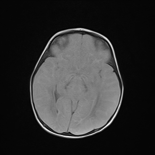 File:Anoxic brain injury (Radiopaedia 79165-92139 Axial FLAIR 13).jpg