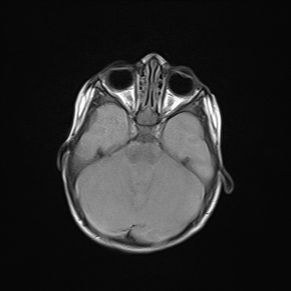 File:Anoxic brain injury (Radiopaedia 79165-92139 Axial FLAIR 9).jpg