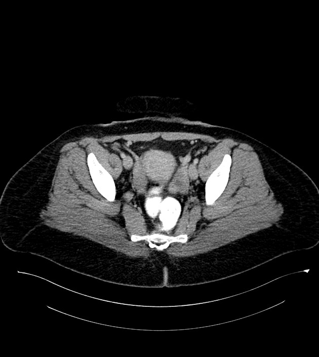 Anterior abdominal wall CSF pseudocyst (CSFoma) (Radiopaedia 79453-92571 A 79).jpg