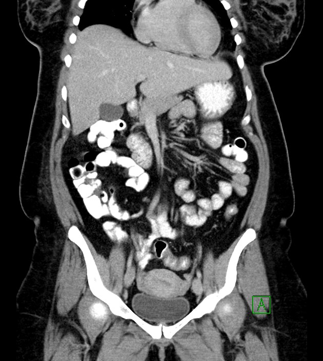 Anterior abdominal wall CSF pseudocyst (CSFoma) (Radiopaedia 79453-92571 B 24).jpg