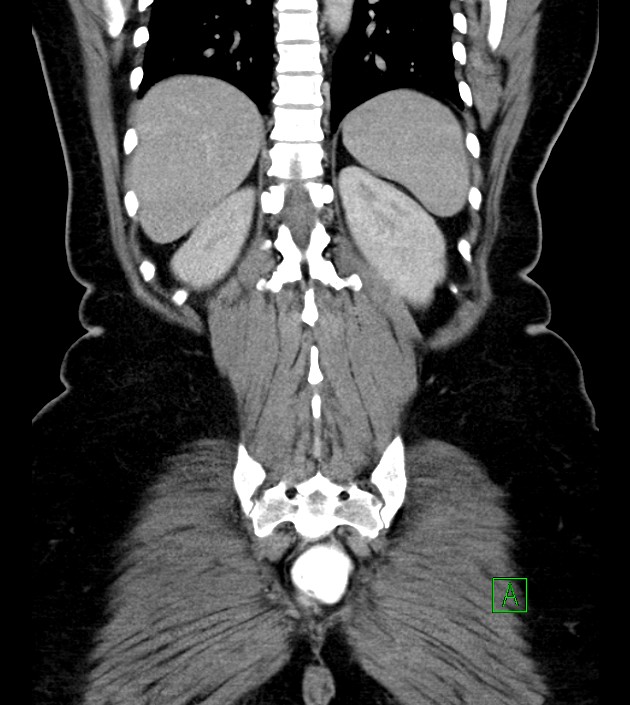 Anterior abdominal wall CSF pseudocyst (CSFoma) (Radiopaedia 79453-92571 B 44).jpg