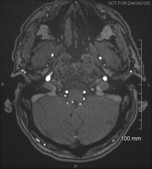 Anterior cerebral artery aneurysm (Radiopaedia 80683-94127 Axial MRA 27).jpg