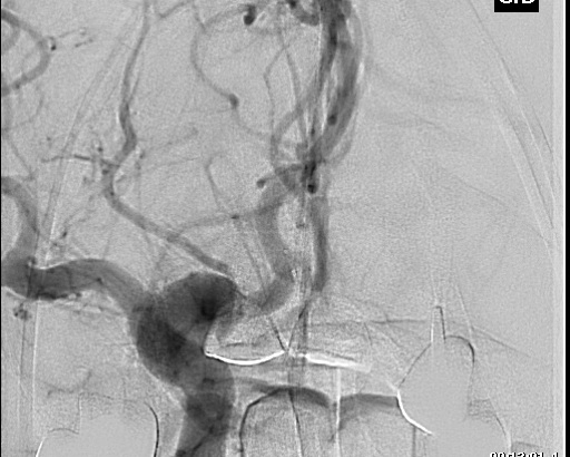 File:Anterior cerebral artery aneurysm (Radiopaedia 80683-94130 A 3).jpg