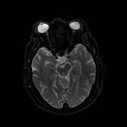 Anterior cerebral artery infarction (Radiopaedia 46794-51323 Axial DWI 39).jpg