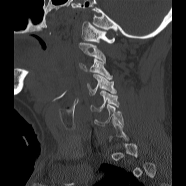 Anterior cervical postdiscectomy arthrodesis (Radiopaedia 32678-33646 Sagittal bone window 18).jpg