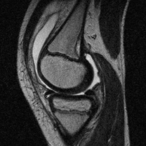 File:Anterior cruciate ligament avulsion fracture (Radiopaedia 24710-24974 Sagittal T2 2).jpg