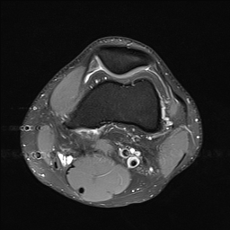 File:Anterior cruciate ligament full thickness tear (Radiopaedia 66268-75467 Axial PD fat sat 7).jpg