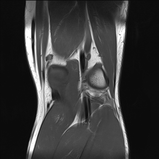 File:Anterior cruciate ligament full thickness tear (Radiopaedia 66268-75467 Coronal T1 17).jpg