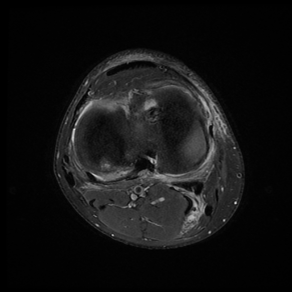 File:Anterior cruciate ligament graft tear and bucket-handle tear of medial meniscus (Radiopaedia 75867-87255 Axial PD fat sat 6).jpg
