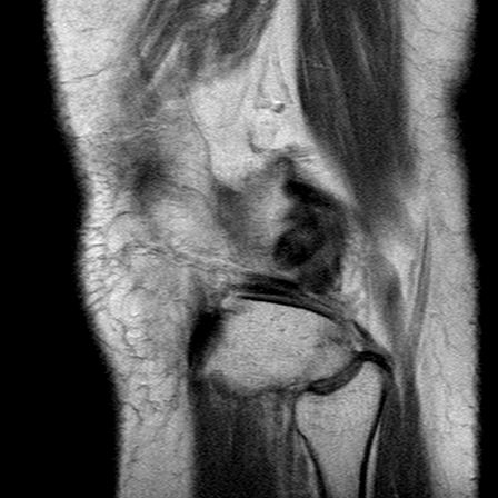 File:Anterior cruciate ligament mucoid degeneration (Radiopaedia 60853-68633 Sagittal PD 25).jpg