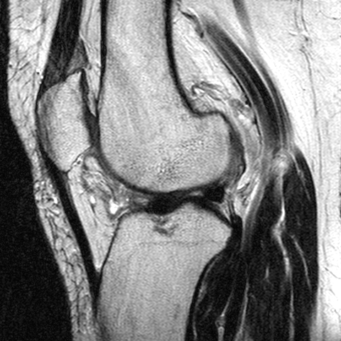 File:Anterior cruciate ligament mucoid degeneration (Radiopaedia 60853-68633 Sagittal T2 18).jpg